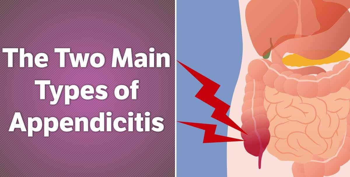 Types Of Appendicitis