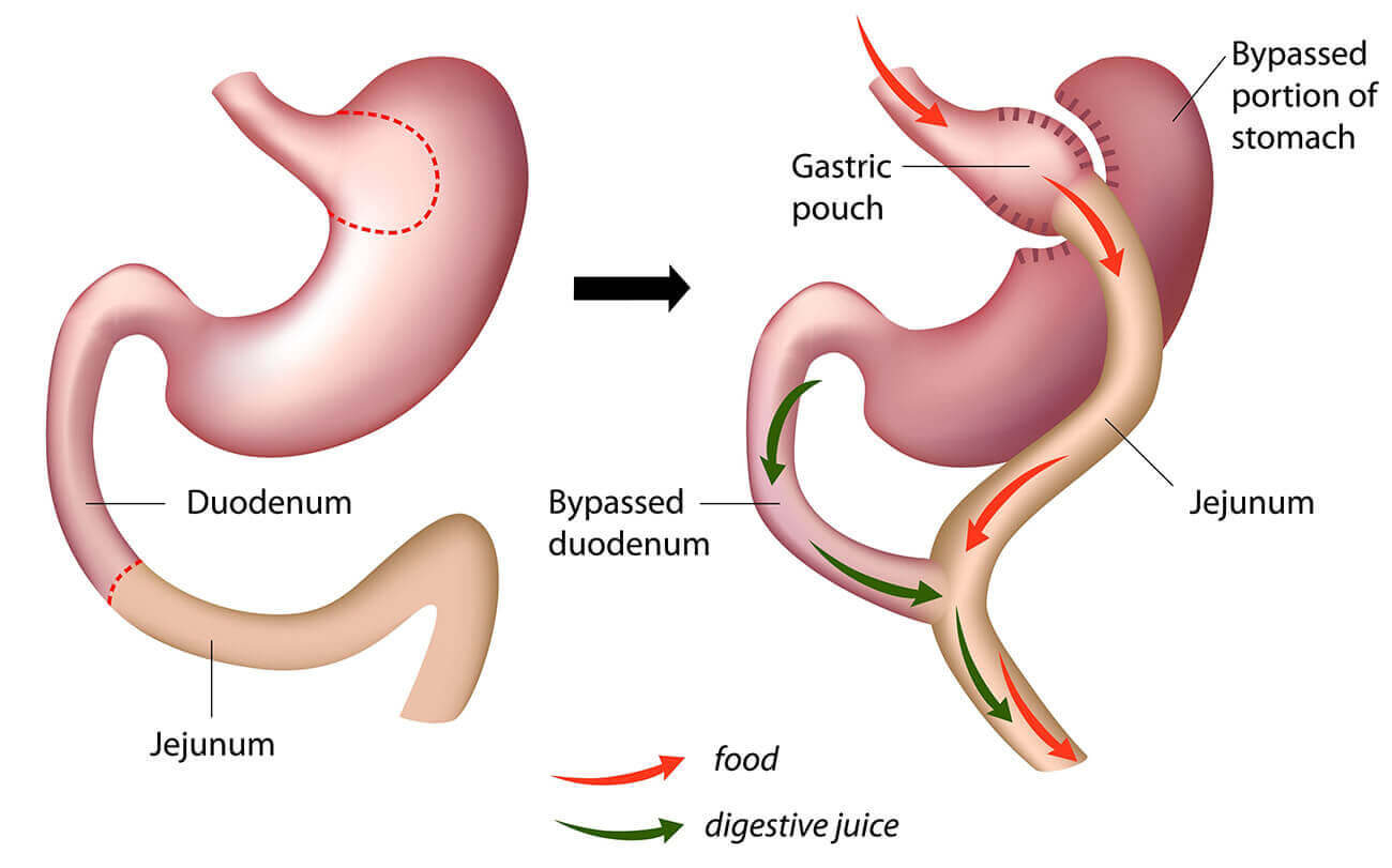 Roux-En-Y Gastric Bypass Surgery