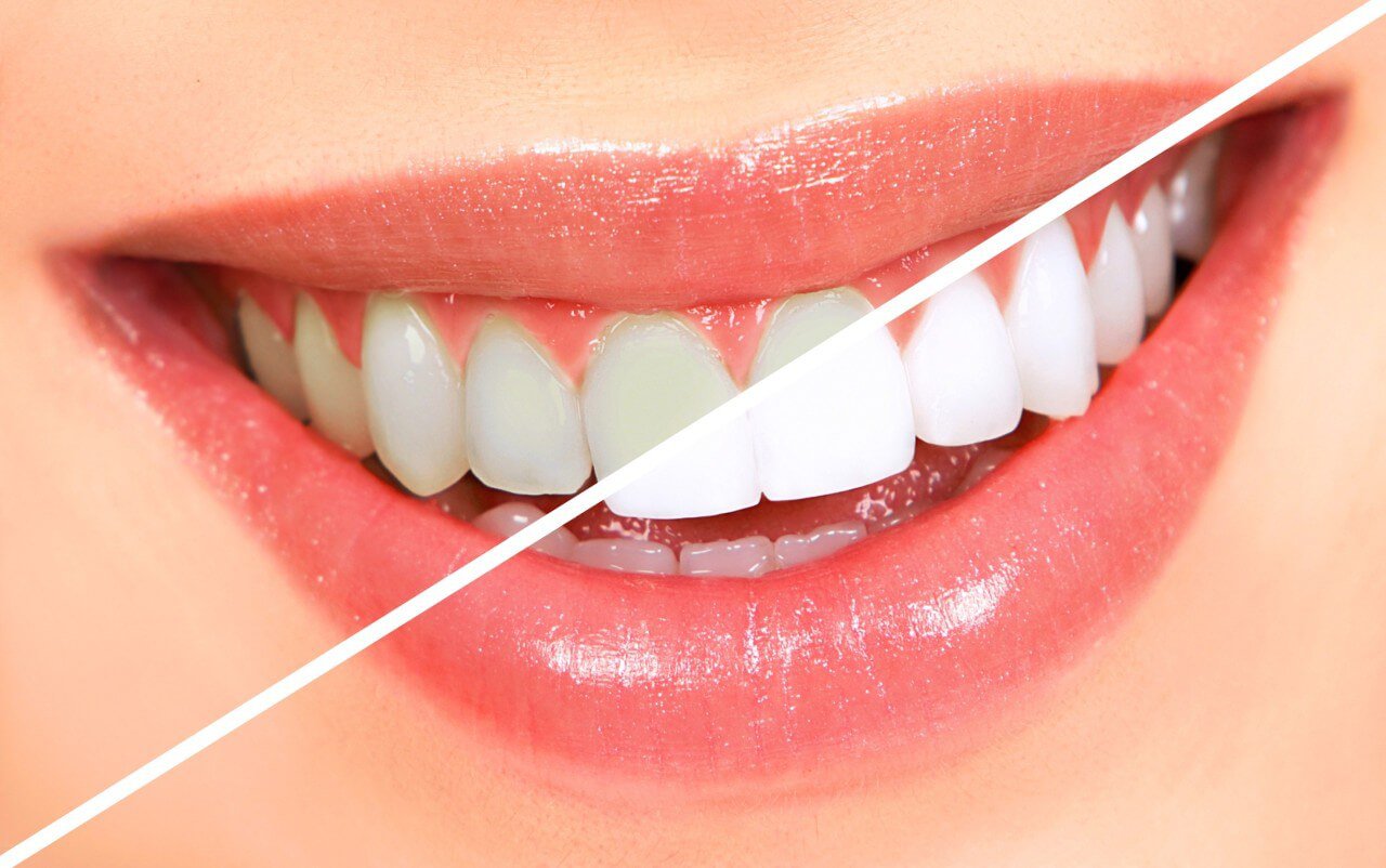 Shiny Teeth
