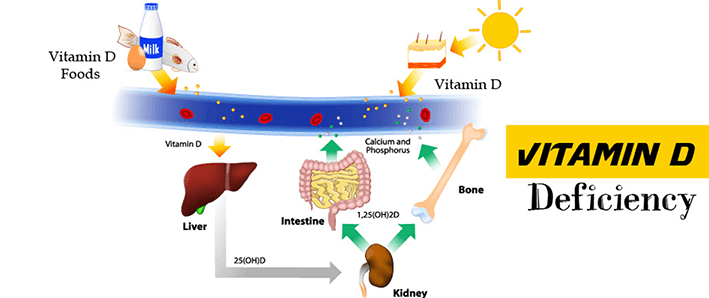 Vitamin D Deficiency
