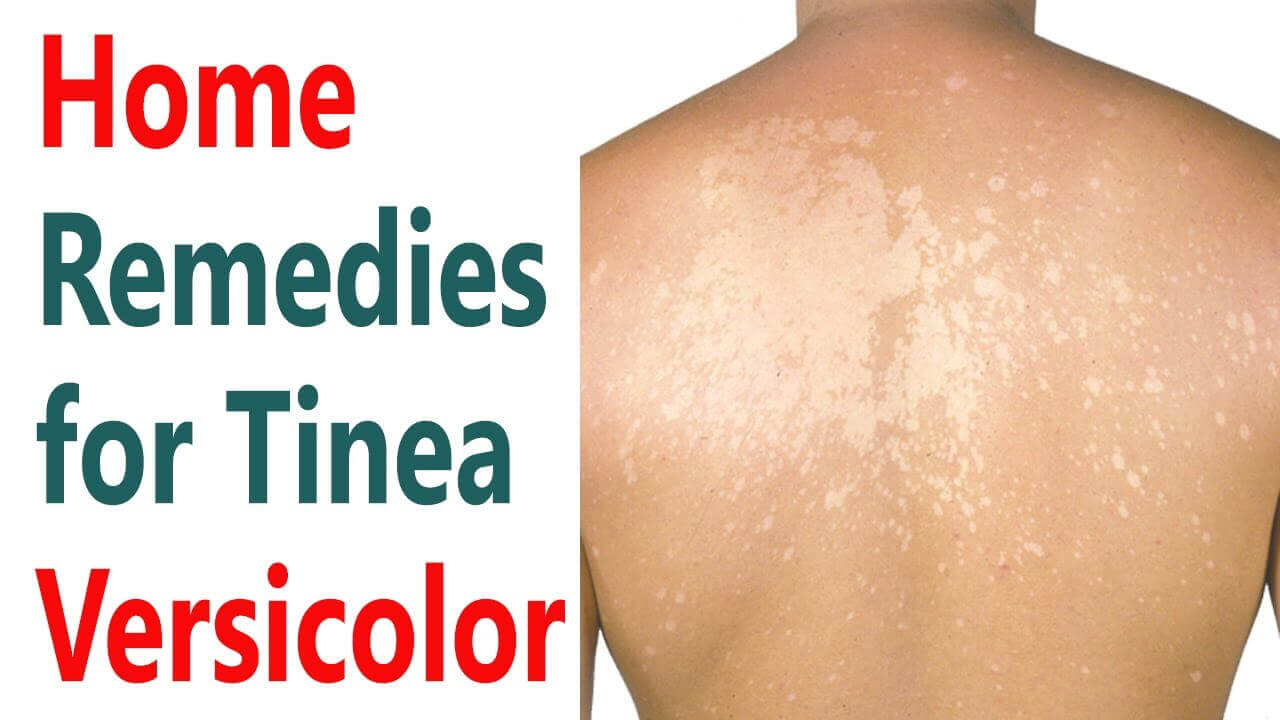 Home Remedies For Tinea Versicolor