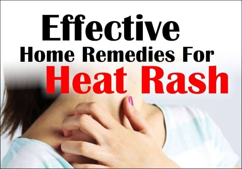 Home Remedies For Heat Rash