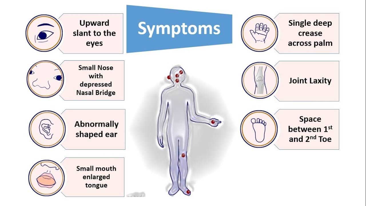Down Syndrome Symptoms