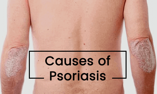 Causes Of Psoriasis